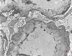 M,36y. | membranous glomerulopathy - late stage M,36y. | membranous glomerulopathy - late stage